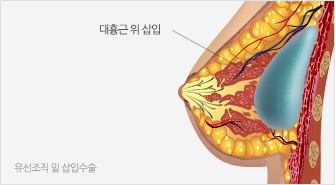 유선조직 밑 삽입수술:대흉근 위 삽입