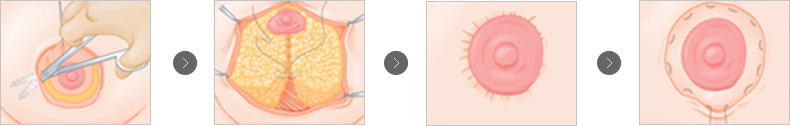 유륜절개법