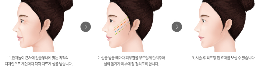 비절개 리프팅