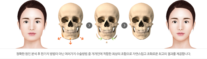 정확한 원인 분석 후 한가지 방법이 아닌 여러가지 수술방법 중 개개인에 적합한 최상의 조합으로 자연스럽고 조화로운 최고의 결과를 제공합니다.