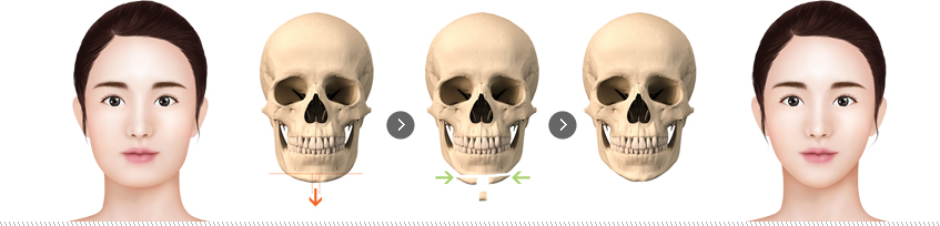 미니 v라인 앞턱 축소술