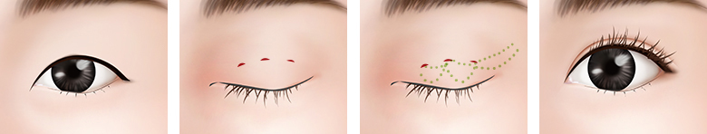 小さな目、薄い皮膚 手術方法