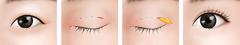 小さな目、分厚い皮膚 手術方法1
