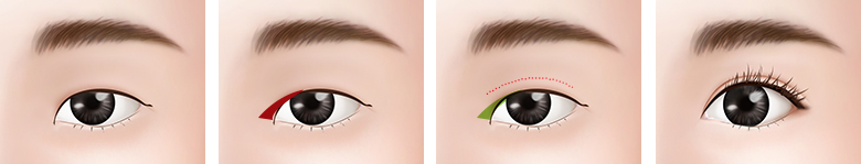 目の間が広く見える目 手術方法