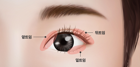 可愛らしくスッキリした目 Jk目頭 目尻切開手術 韓国政府認証jk美容外科