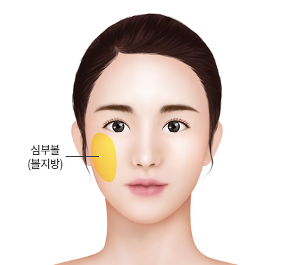 심부볼(볼지방)