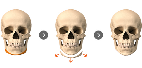 下顎全周骨切り術