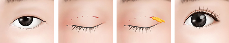 маленькие глаза плотная кожа Метод проведения операции1