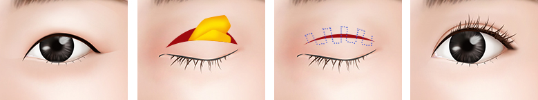 маленькие глаза плотная кожа Метод проведения операции2