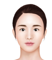Mini V-Line – Front Jaw Reduction Surgery